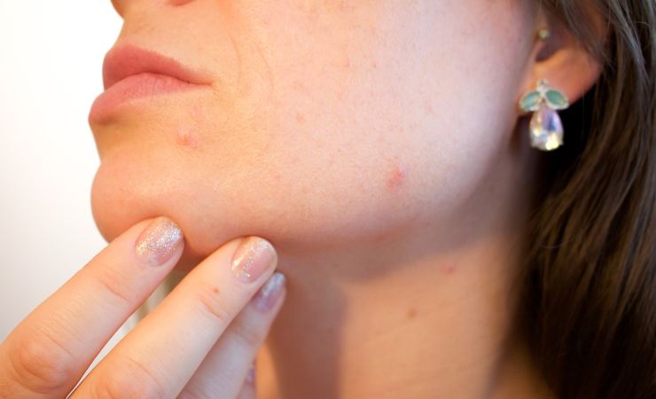 acne viso