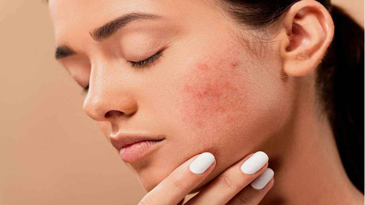 acne viso