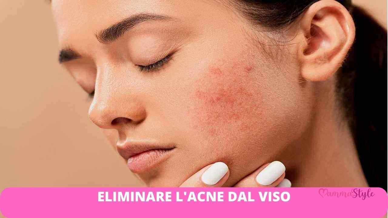 acne viso