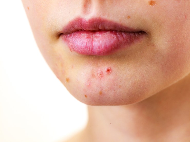 acne viso