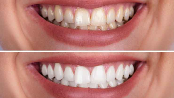 Denti prima e dopo