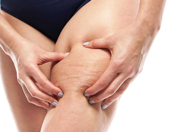 Cellulite buchi gobbette buccia d'arancia 