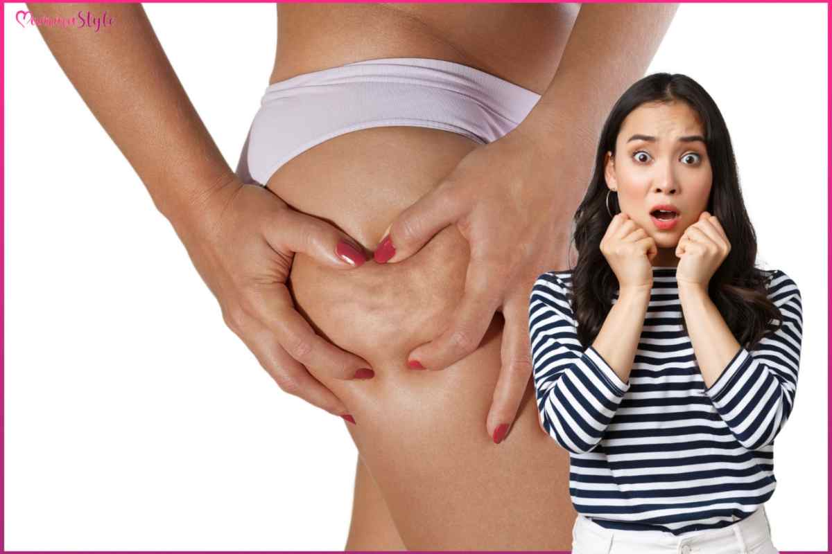 cellulite cosa fare