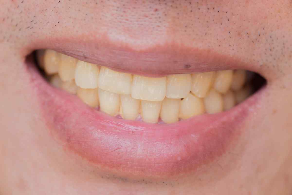 Alimenti che ingialliscono i denti