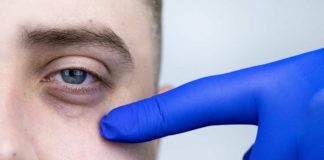 Come risolvere il problema delle occhiaie