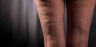 Come combattere la cellulite