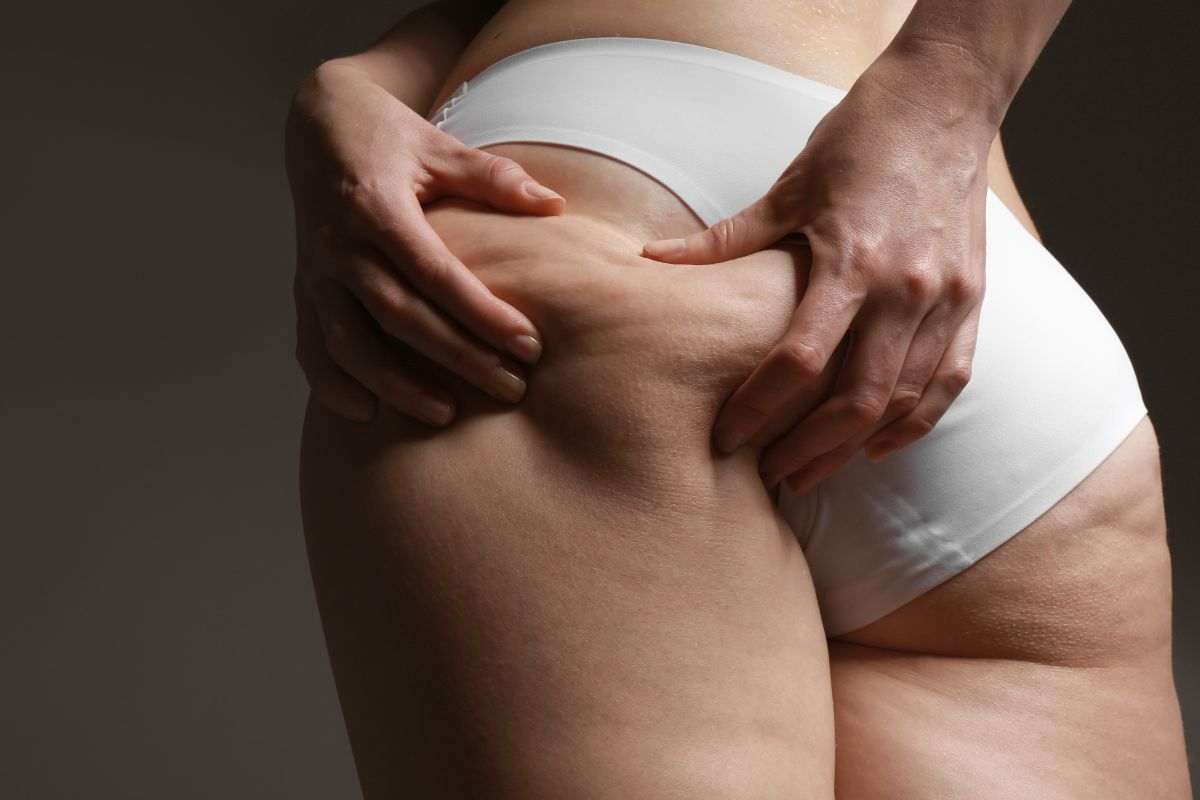 cellulite rimedi creme scoperte nuove