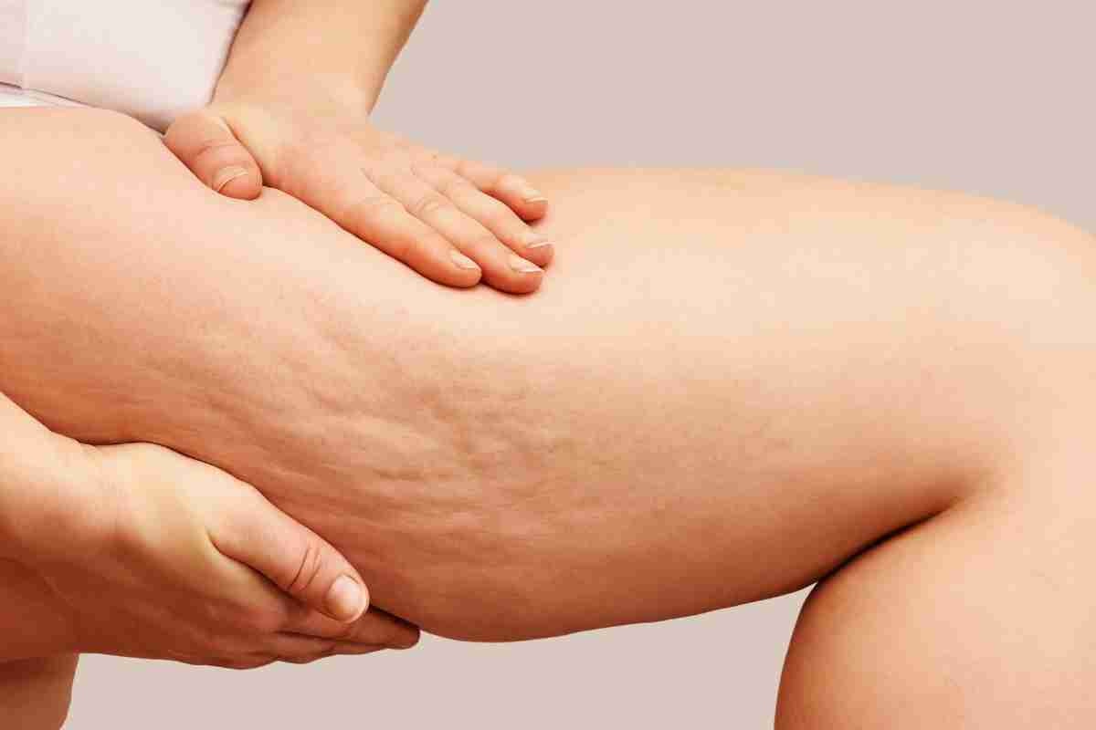 cellulite rimedi creme scoperte nuove