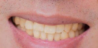 denti gialli motivo