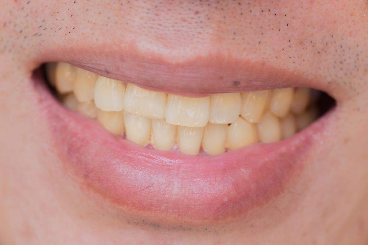 denti gialli motivo