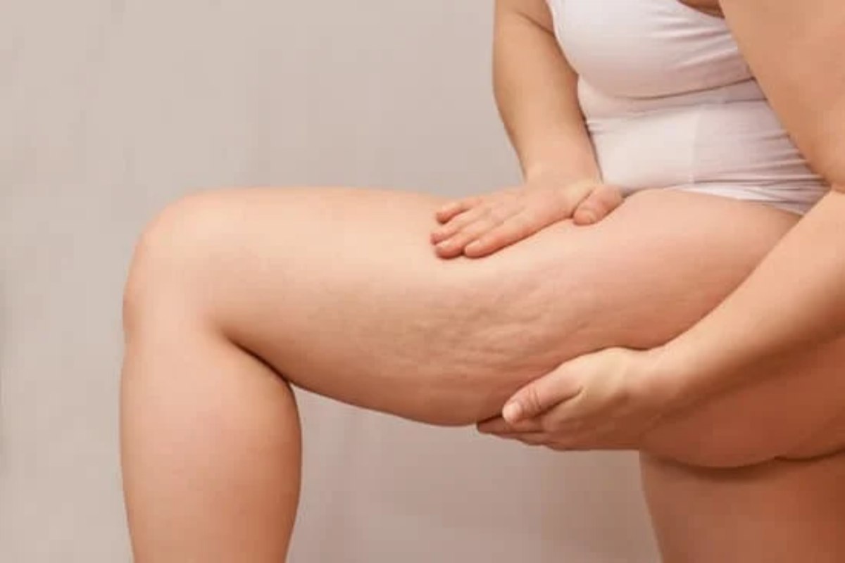 cellulite ritenzione idrica distinzione