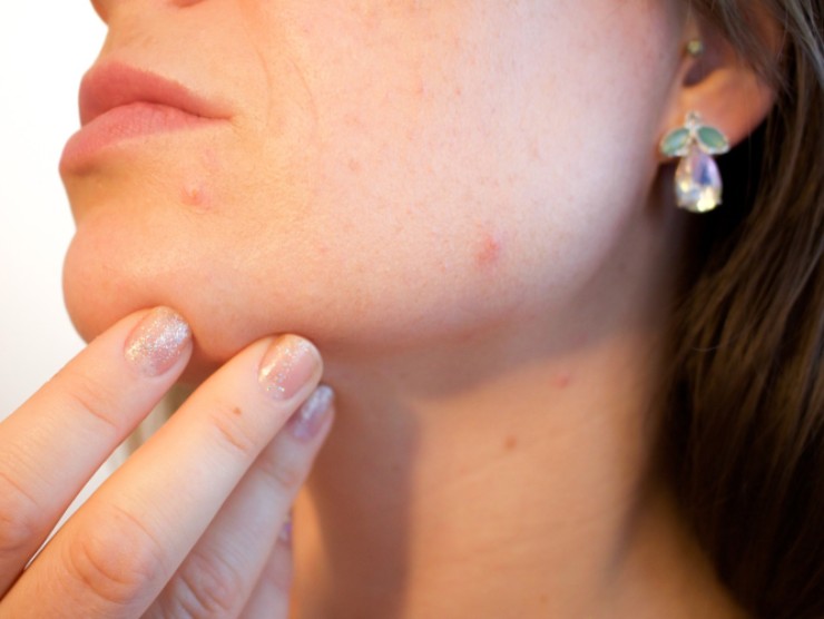 Molecola contro acne